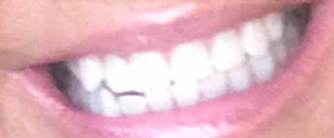 after teeth whitening