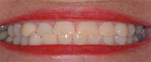 before teeth whitening