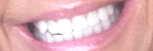 , Smile Gallery