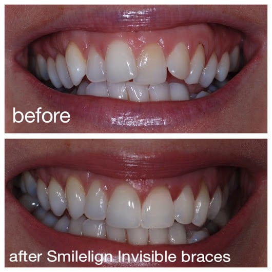 Invisible Braces, Braced up in Bournemouth