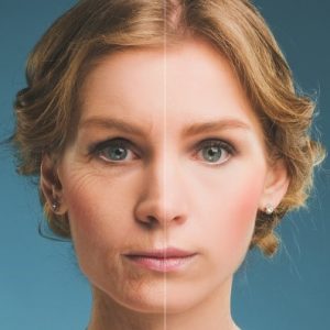 Wrinkle rejuvenation treatment in Bournemouth, Best Wrinkle Treatment in Bournemouth
